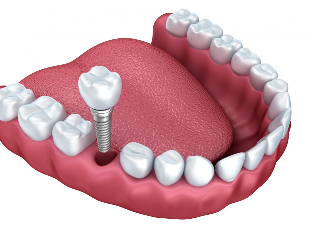 implant-dentaire-unitaire-e1446056885287