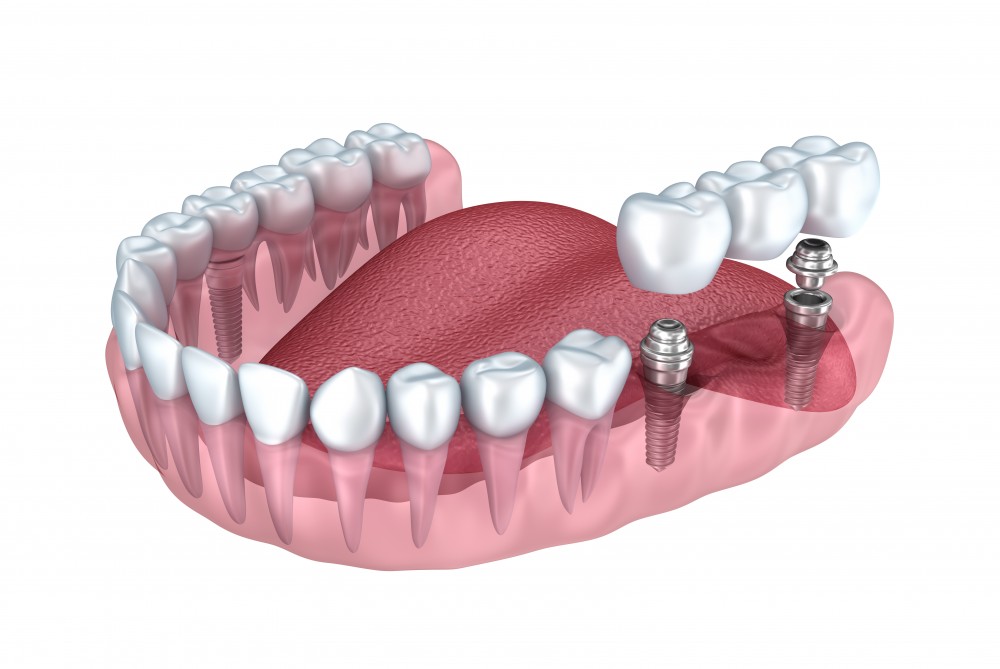 pont-sur-implants-dentaires